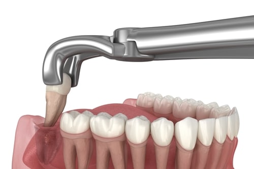 Extraction in Sonora, CA | Sonora Dentist