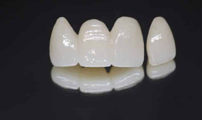Crowns and Bridges in Sonora, CA Dental Crown & Dental Bridge