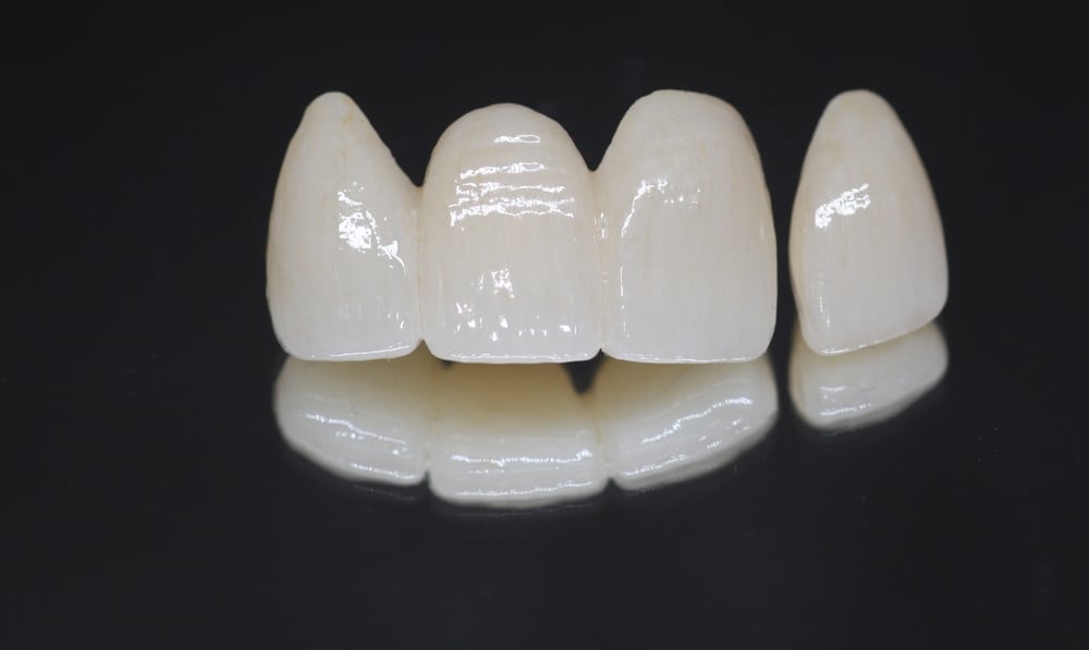 Crowns and Bridges in Sonora, CA Dental Crown & Dental Bridge