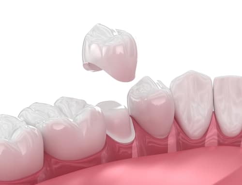 Corona Dental en Sonora, CA | Restaurar su sonrisa hoy