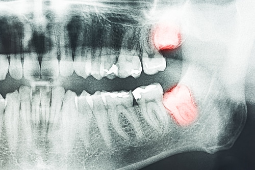 Extractions in Sonora, CA Pain-Free Dental Extractions Near Me