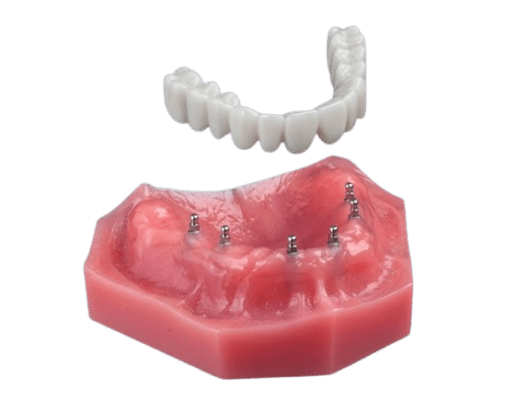 Dentures in Sonora, CA | Roundhouse Bridge at Sonora Dentist