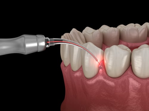 Gum Disease Treatment in Sonora, CA | Restore Your Oral Health
