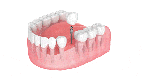 Oral Surgery in Sonora, CA | Mini Dental Implant Placement