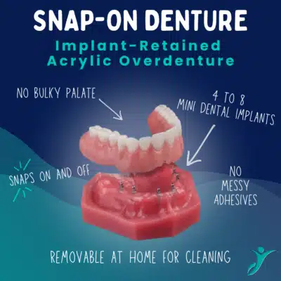 Overdentures in Sonora, CA Removable Snap-On Dentures