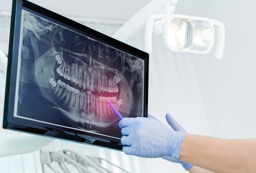 Oral Surgery in Sonora, CA | Restore Your Oral Health