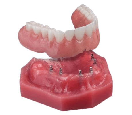 Dentaduras Flojas en Sonora, CA | Dentaduras Snap-in Asegurar su Sonrisa