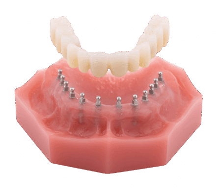 Opciones de prótesis en Sonora, CA | Reserve una consulta gratuita de implantes