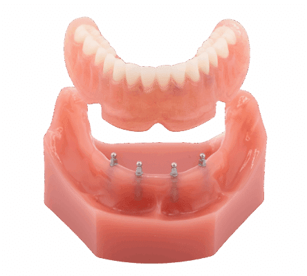 Snap-in Dentures in Sonora, CA | Book a Free Implant Consultation