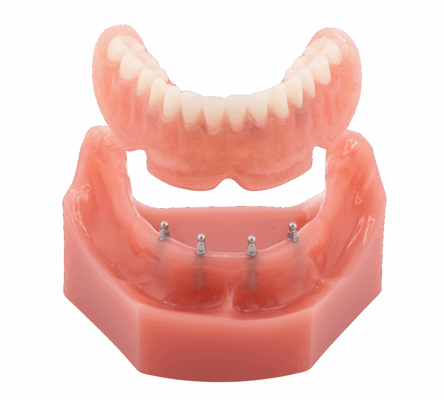 Snap-in Dentures in Sonora, CA | Book a Free Implant Consultation