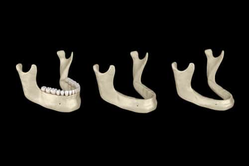 Affordable Dental Implants in Sonora, CA | Prevent Jawbone Resorption