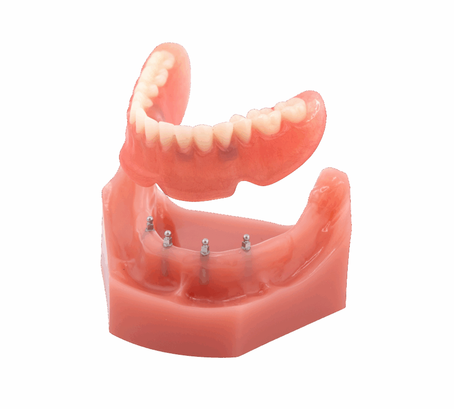 Snap-On Dentures in Sonora, CA | Free Mini Implant Consultations