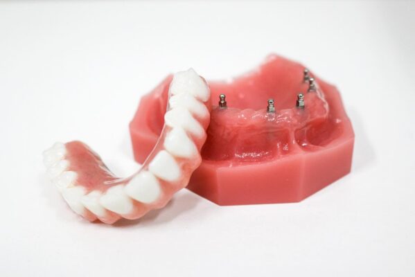 Dentures in Turlock, CA [Video Inside] | Roundhouse Bridge Implant Dentures