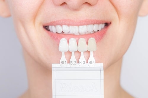 Dentista en Sonora, California | Procedimiento de carillas de porcelana