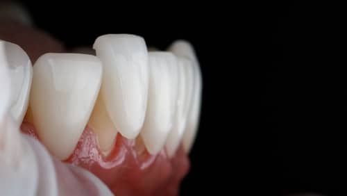Cosmetic Dentist in Sonora, CA [Video FAQs] | Dental Veneer Transformation