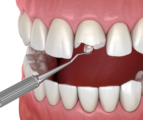 Diente roto en Sonora, CA | Atención dental de emergencia cerca de mí