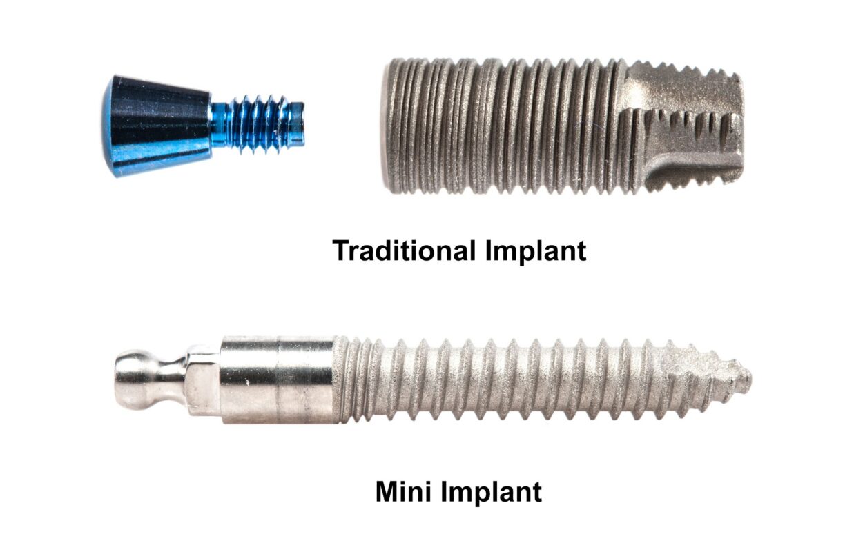 Small-Diameter Dental Implants in Sonora, CA | Free Consultations
