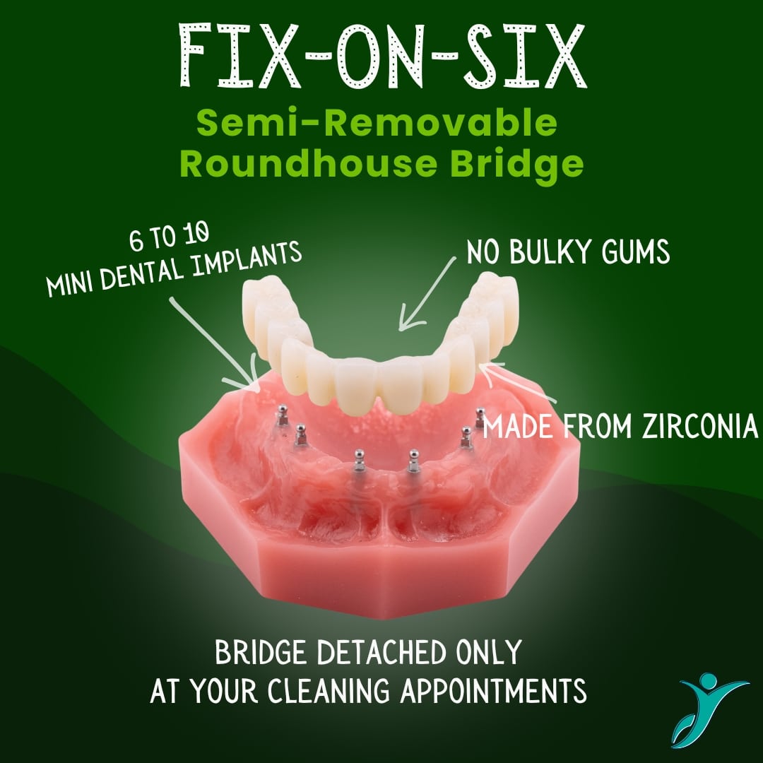 Fix On Six Implant Denture - Sonora Dentist