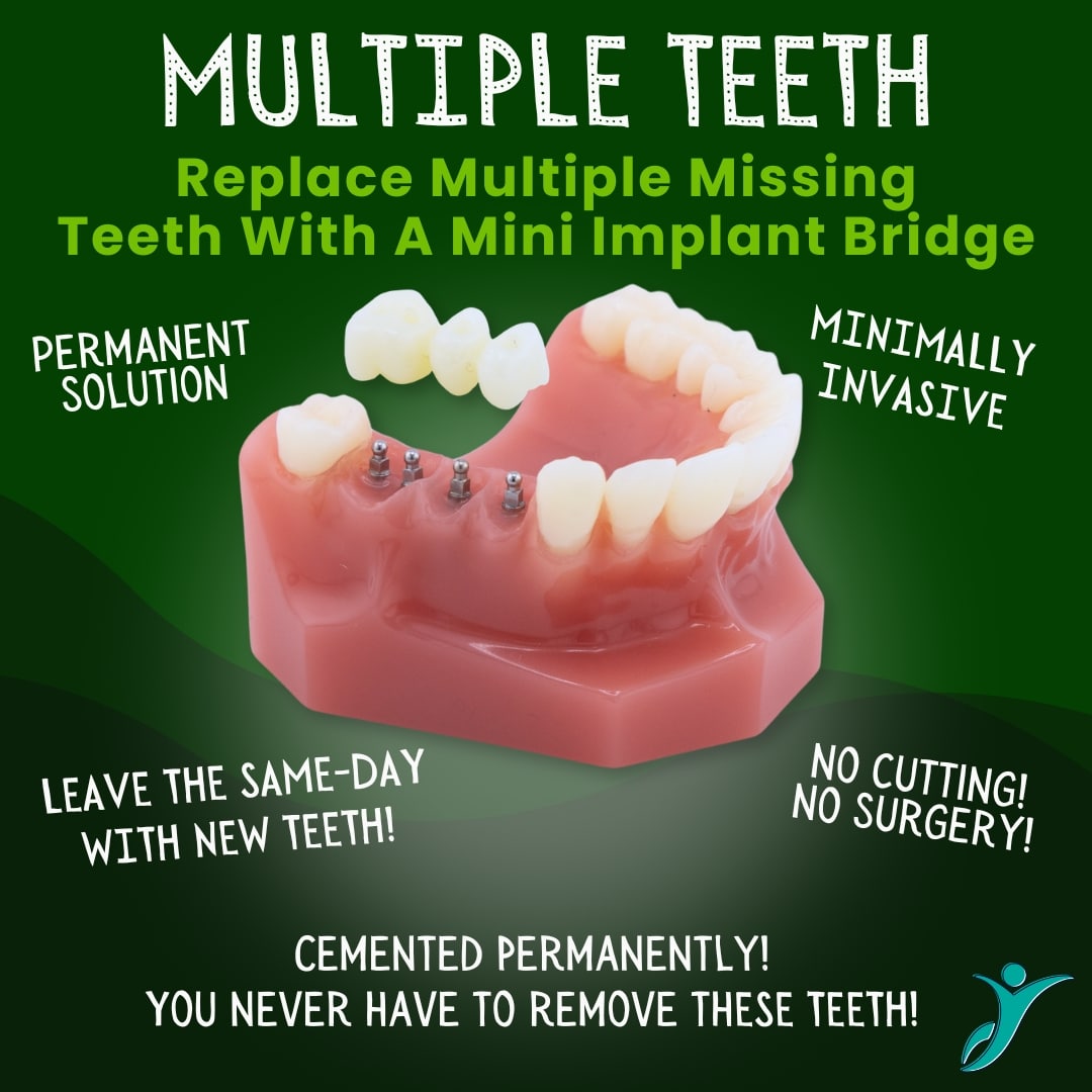 Replace Multiple Teeth - Sonora Dentist
