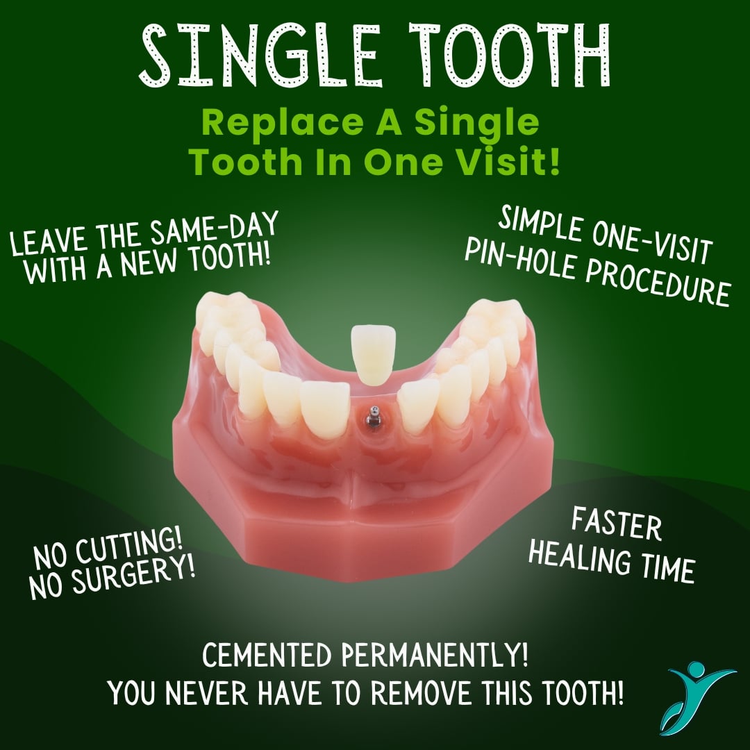 Replace Single Teeth - Sonora Dentist