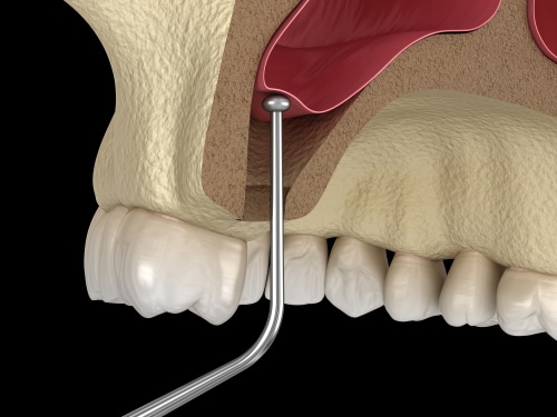 Sinus Lift in Sonora, CA | Book a Free Dental Implant Consultation