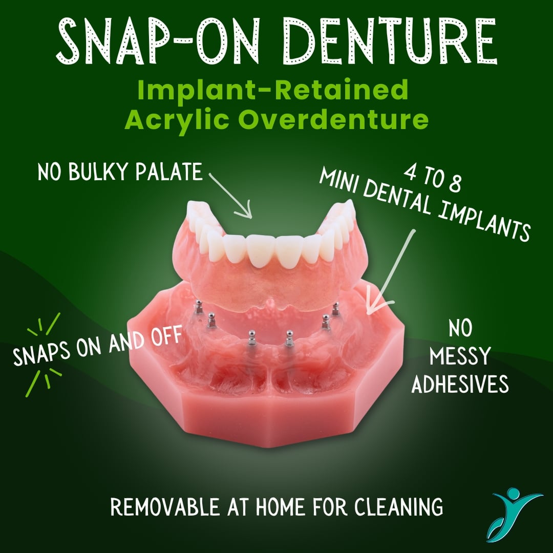 Snap On Denture - Sonora Dentist