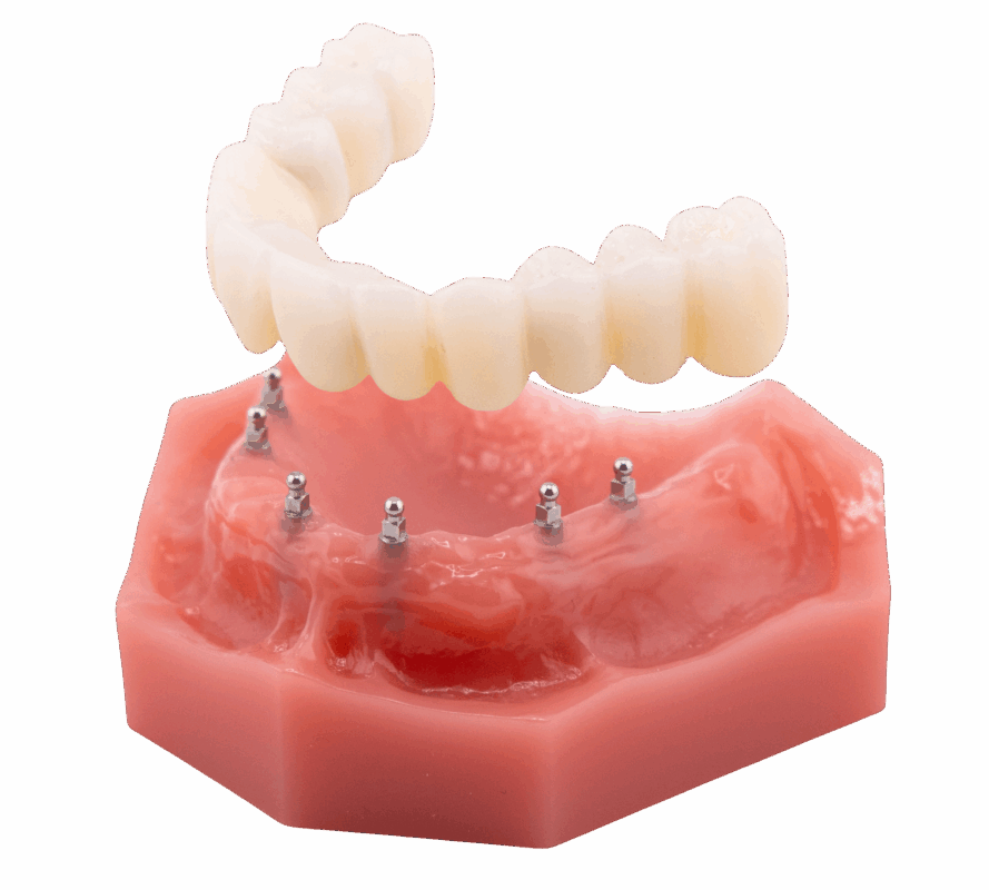 Mini Implant Dentures in Sonora, CA | Free Implant Consultations
