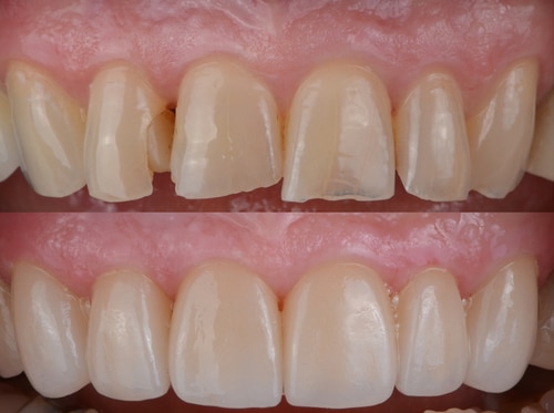 Dental Bondings in Sonora, CA | Cosmetic Dental Bonding