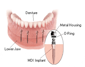 Mini Implant in Sonora, CA | Book a Free Consultation | Dr. Berger
