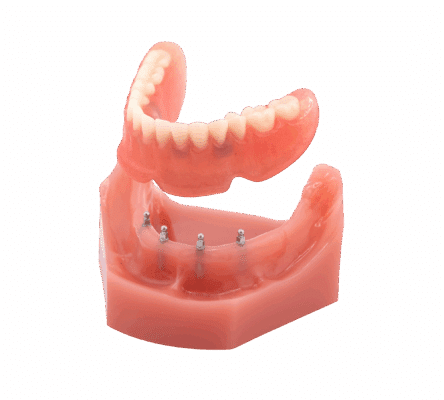 Snap-On Dentures in Sonora, CA | Free Mini Implant Consultations