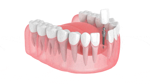 Permanent Teeth in Sonora, CA | Restore Your Smile With Mini Implants