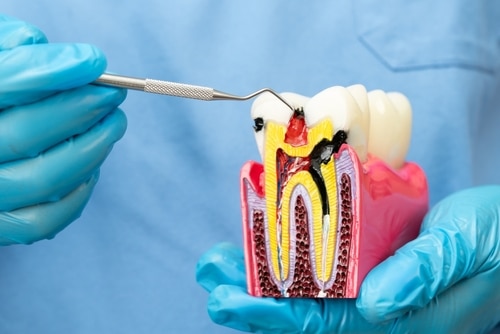 What Exactly Happens in a Root Canal? | Dental Q&A in Sonora, CA