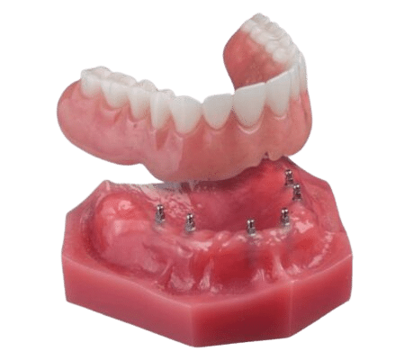 Fix-on-Six in Sonora, CA | Book a Free Mini Implant Consultation