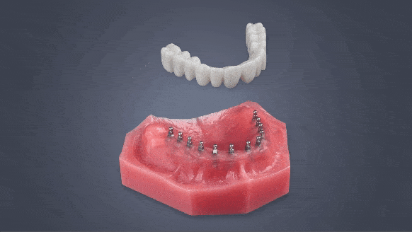 Mini Dentures [Video Guide] | Secure Your Smile in Place With Mini Implants