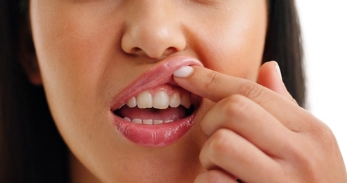 Reverse Gum Disease [Video Q&A] | Gum Care in Sonora, CA