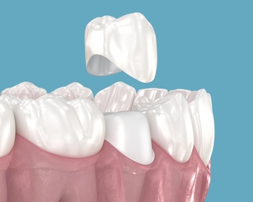 Corona tras tratamiento de conducto en Sonora, CA | Dentista de emergencia cerca de mí
