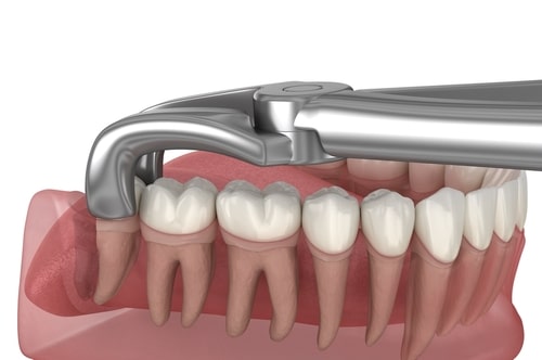 Wisdom Tooth Extraction in Sonora, CA | Sedation Options Offered